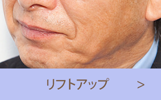 リフトアップ